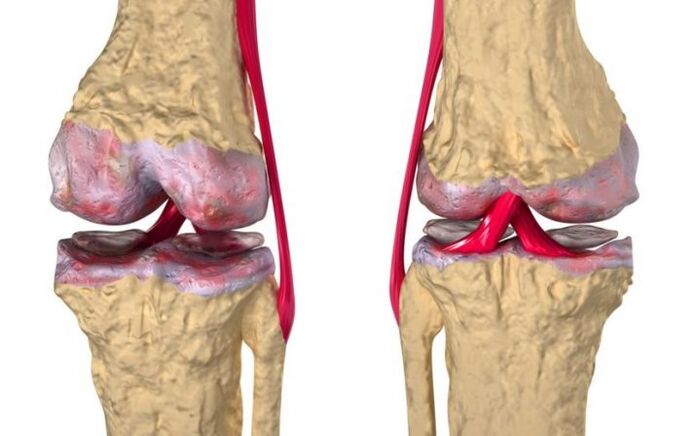 Osteoartritis kolenskega sklepa
